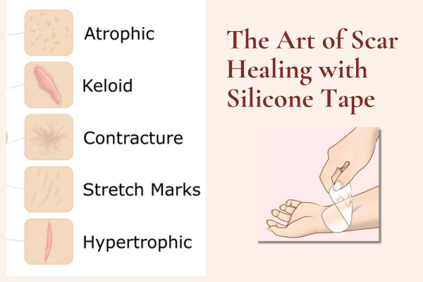 The Art of Scar Healing with Silicone Tape